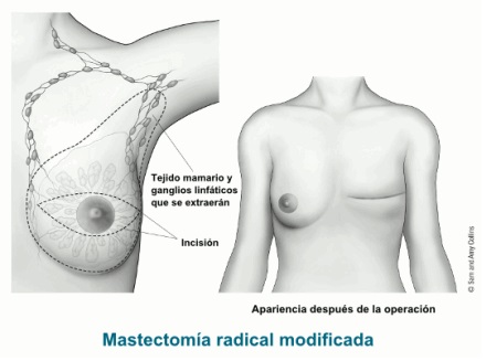 mastectomiaradical