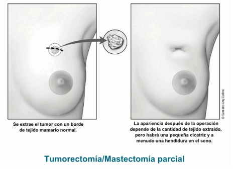 tumorectomia